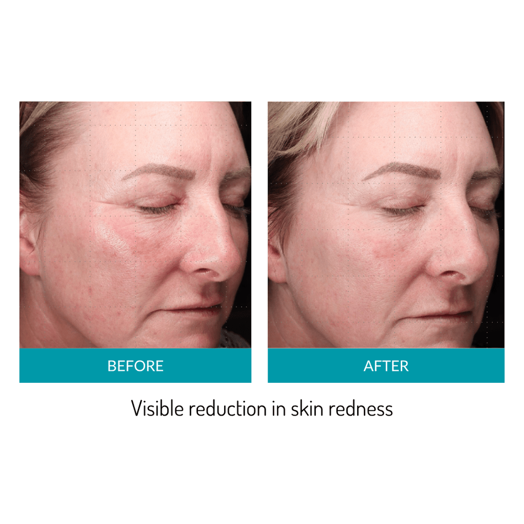 Glo Mask Anti-Aging LED Phototherapy Mask